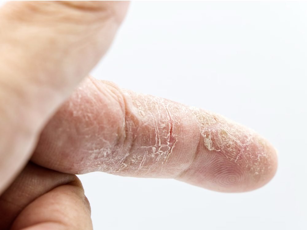 Close-up of dry, cracked skin on a hand, a common sign of low indoor humidity